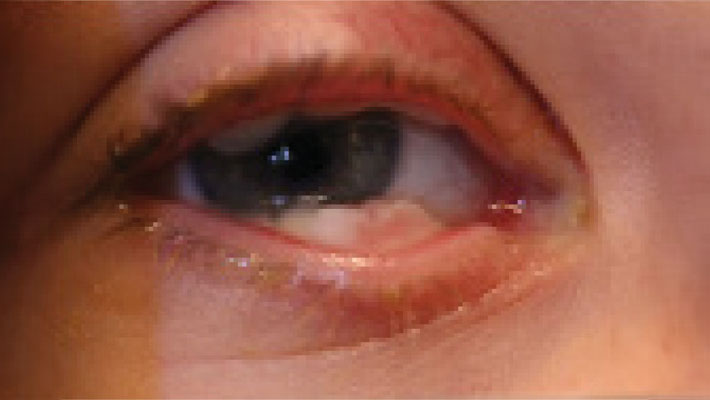 Middle stage ligneous conjunctivitis presenting as a white palpebral conjunctival lesion